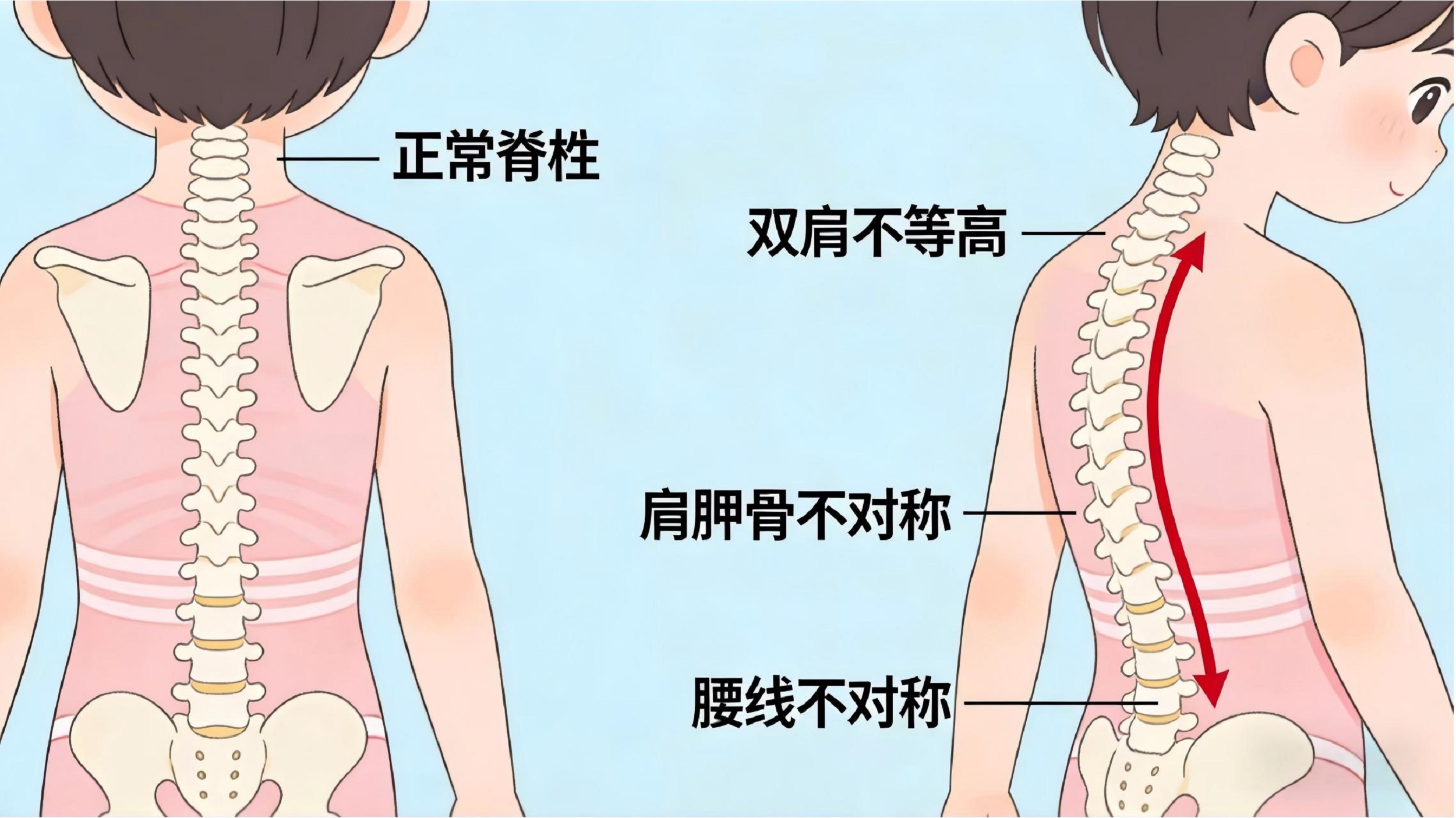 脊柱的“悄悄话”:别让孩子的成长被“压弯了腰”(图2)