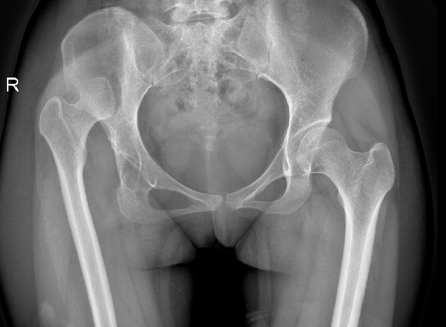 21 岁女孩的蜕变：跨越先髋难题 从跛行到从容行走