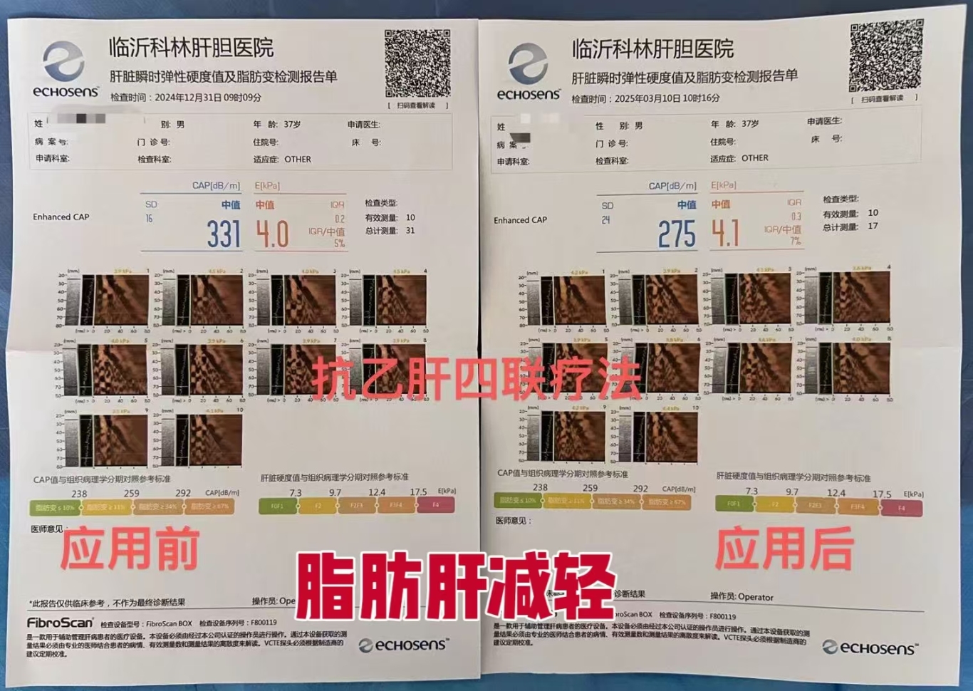 表2   脂肪肝减轻.jpg
